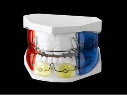 Transforming Orthodontic Treatment: The Precision of Frankel II Appliances